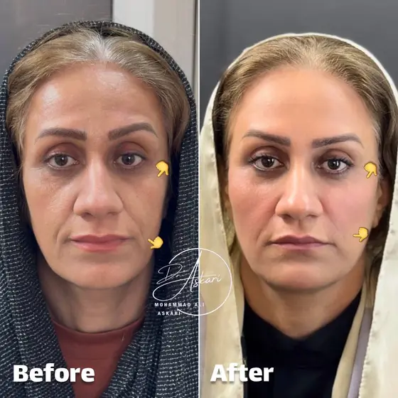 فیلر گونه و خط خنده اصلاح خط لبخند، قبل و بعد، کلینیک زیبایی دکتر عسکری