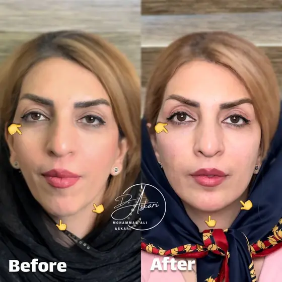 اصلاح نچرال لاغری صورت با دقت به زوایای صورت (چانه/گپ چانه/زاویه فک/گونه)، قبل و بعد، کلینیک زیبایی دکتر عسکری