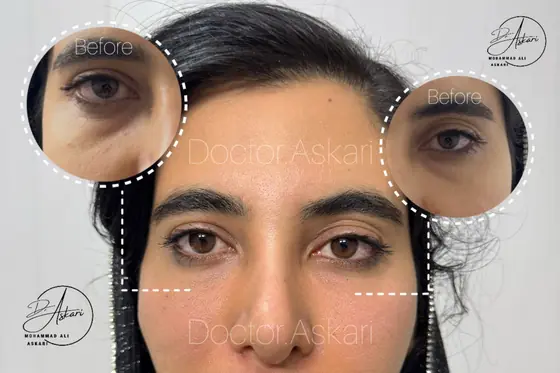 فیلر زیرچشم، قبل و بعد، کلینیک زیبایی دکتر عسکری