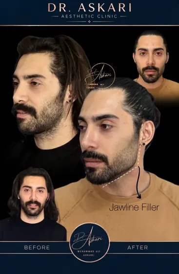 فیلر زاویه فک اصلاح فرم صورت، قبل و بعد، کلینیک زیبایی دکتر عسکری